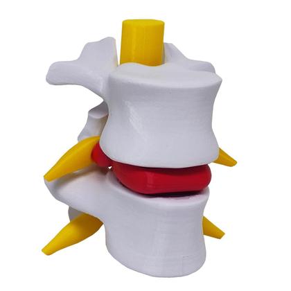 Imagem de Modelo Anatômico Hérnia Disco Lombar Coluna Vertebral